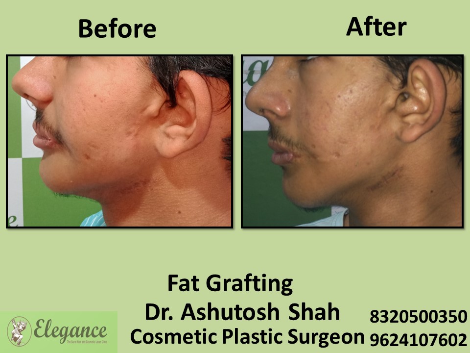 Fat Grafting, Fat Removal in Vesu, Surat