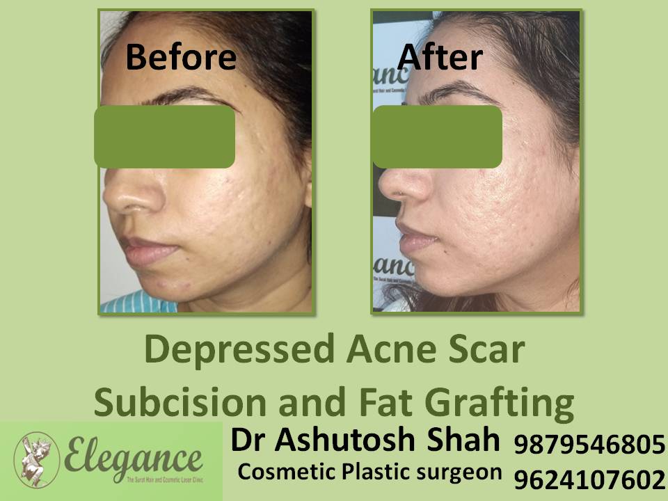 Depress Scar Subcision With Fat Grafting In Jaipur, Rajasthan, India