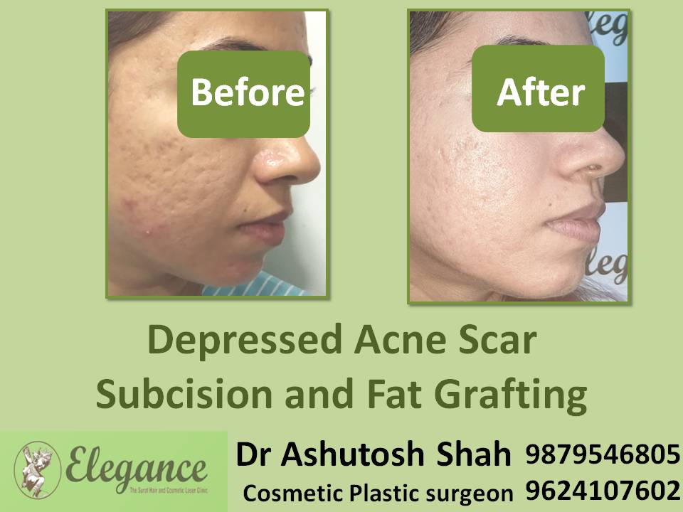 Depress Scar Subcision With Fat Grafting in Bhopal, Madhya Pradesh, India