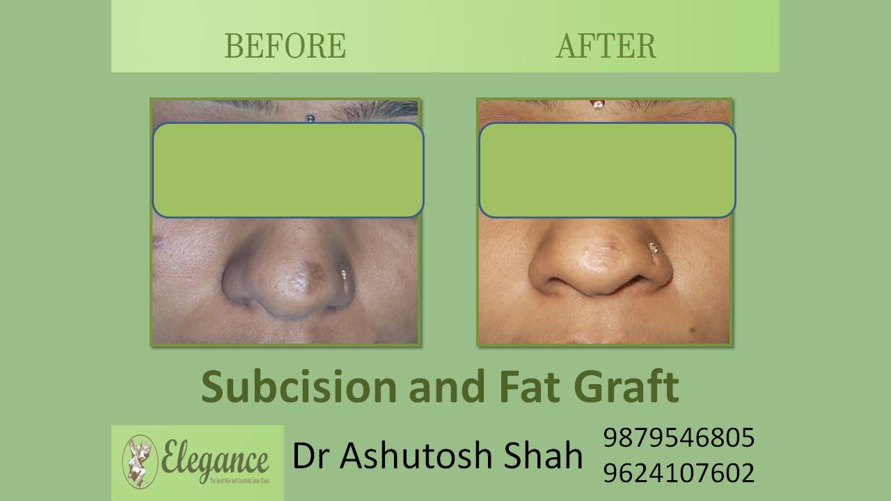 Subcision Fat Grafting In Surat, Gujarat, India