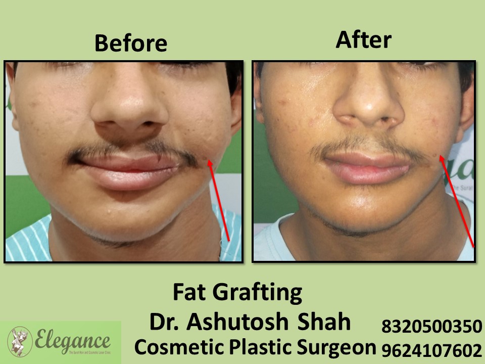 Fat Grafting, Fat Removal in Athwagate, Vesu, Surat