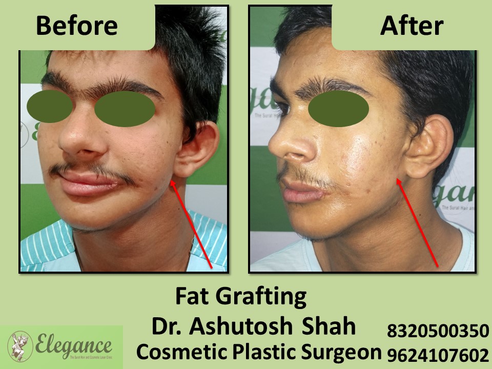 Fat Grafting, Fat Removal in Udhna,Vesu, Surat