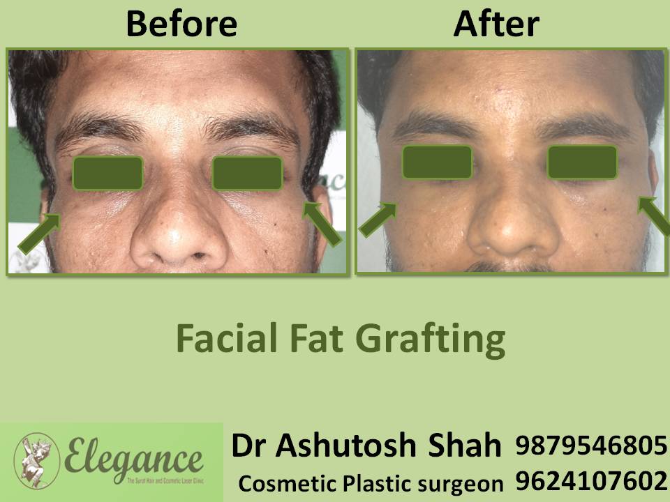 Facial Fat Grafting In Vapi, Gujarat, india
