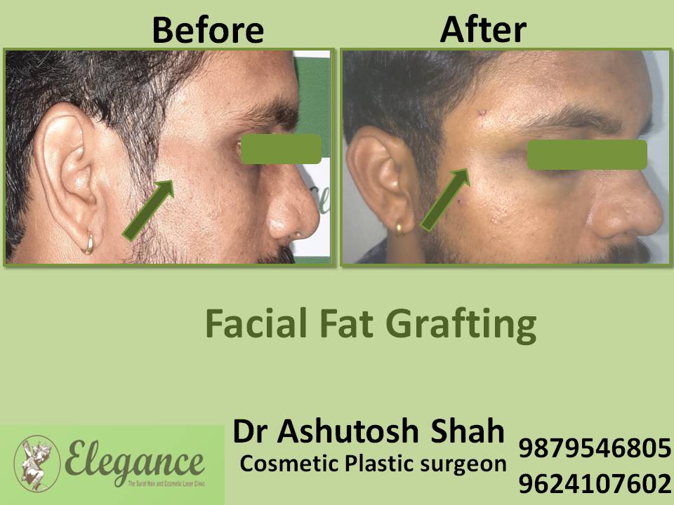 Facial Fat Grafting In Surat, Gujarat, India