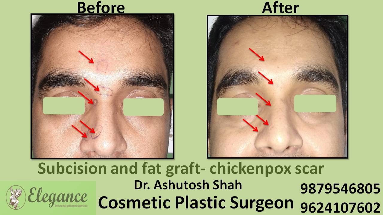 Subcision With Fat Grafting In Surat, Gujarat, India
