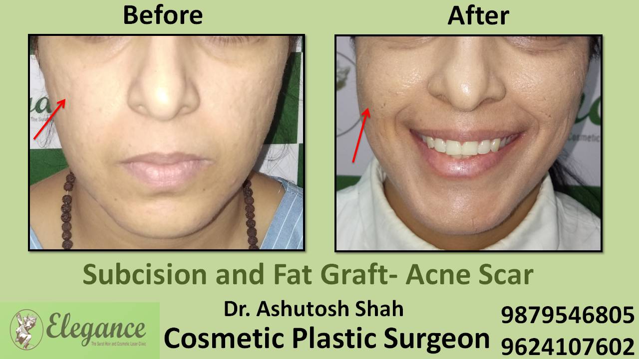 Subcision With Fat Grafting In Vapi, Gujarat, India