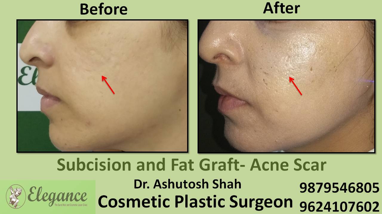 Subcision With Fat Grafting Cost In Surat, Gujarat, India