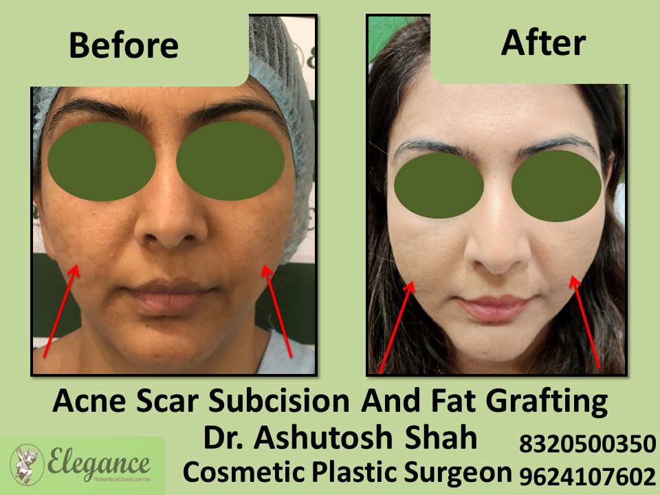Acne Scar Subcision Fat Grafting Surgery, Acne Removal, Painless Process, Acne Treatment in Vesu,Surat