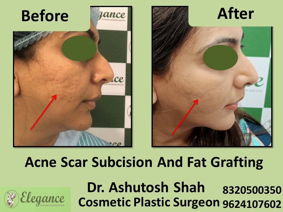 Acne Scar Subcision Fat Grafting Surgery, Acne Treatment in Athwagate, Surat