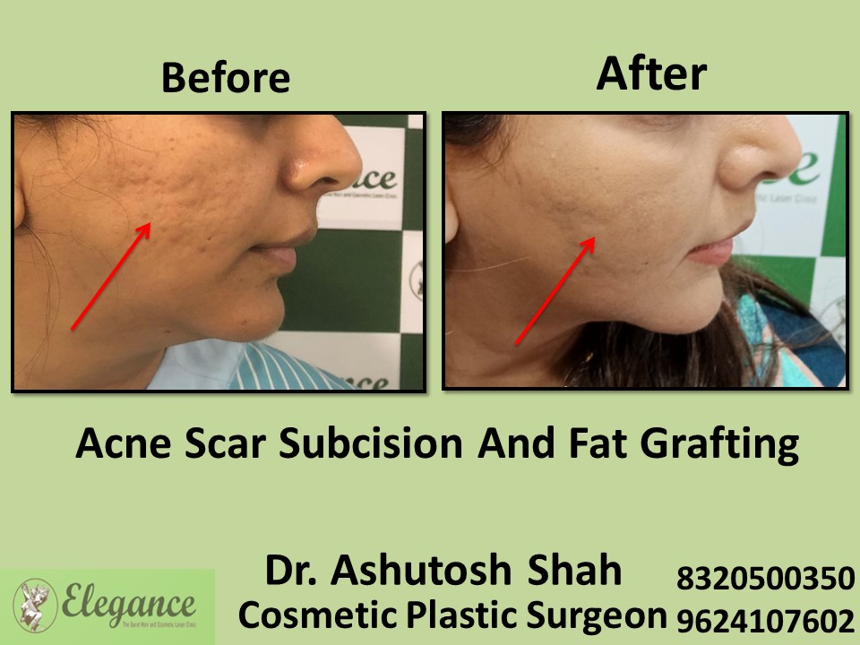 Acne Scar Subcision Fat Grafting Surgery, Acne Treatment in Piplod, Surat