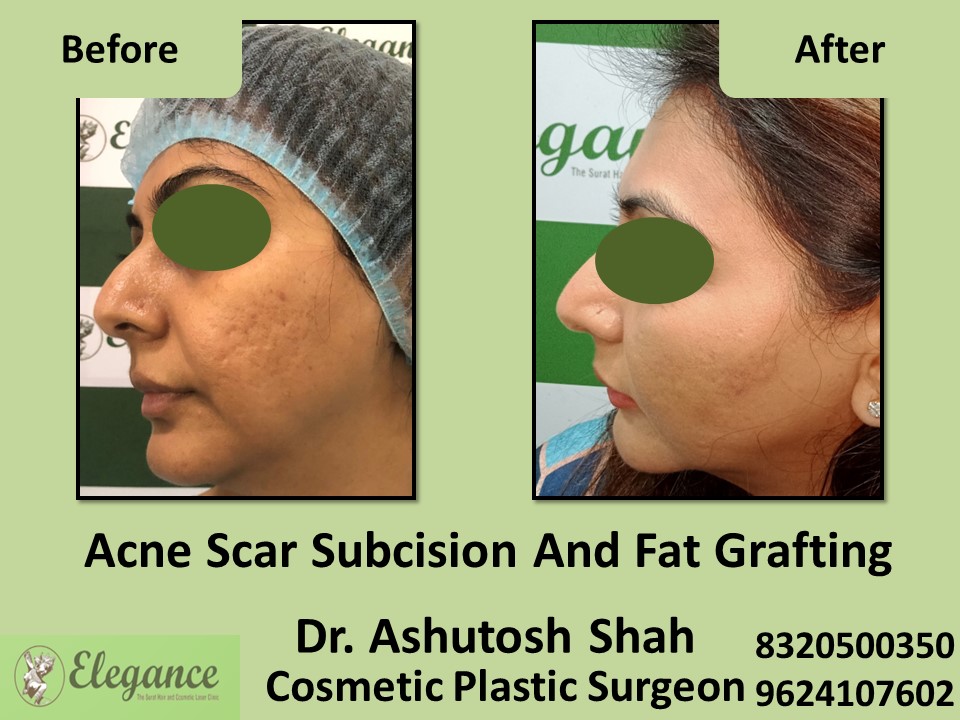 Acne Scar Subcision Fat Grafting Surgery, Acne Treatment in Vesu, Surat