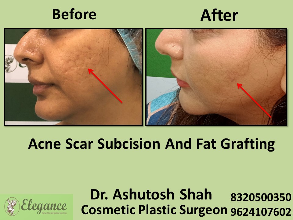 Acne Scar Subcision Fat Grafting Treatment in Udhna, Surat