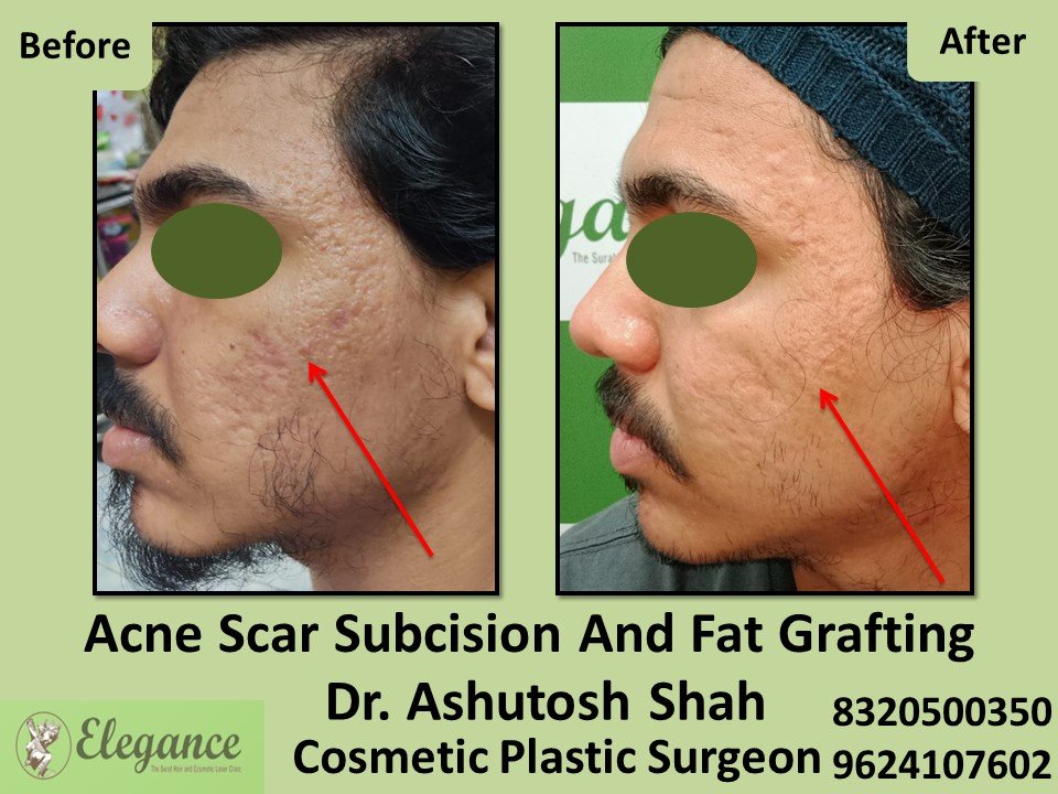 Acne Scar Subcision Fat Grafting Treatment in Udhna, Surat