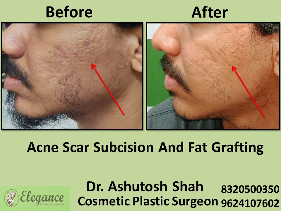 Acne Scar Subcision Fat Grafting Treatment in Udhna, Piplod, Surat