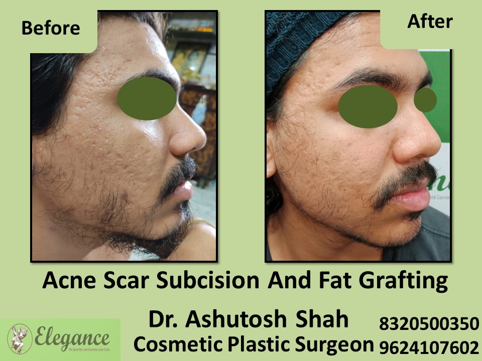 Acne Scar Subcision Fat Grafting Treatment, Acne Removal in Piplod, Surat