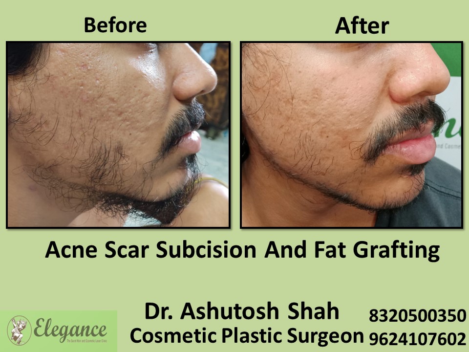 Acne Scar Subcision Fat Grafting Treatment, Acne Removal in Adajan, Surat
