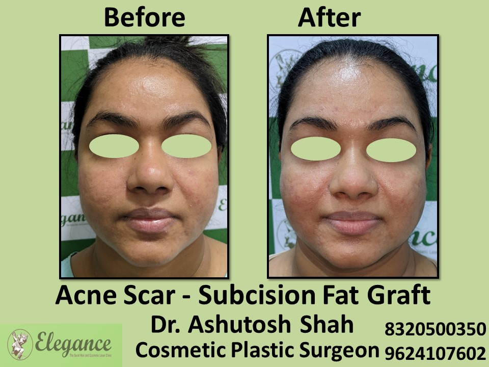 Acne Scar, Subcision Fat Graft in Vesu, Surat