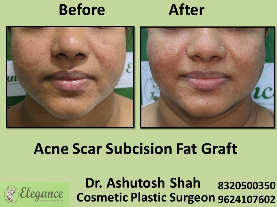 Acne Scar Subcision Fat Graft, Acne Treatment in Pal, Surat