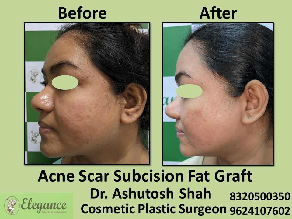 Acne Scar Subcision Fat Graft, Acne Treatment in Vesu, Surat