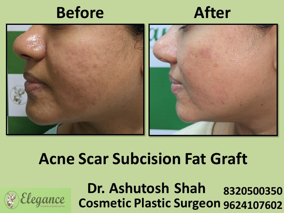 Subcision Fat Graft, Acne Treatment in Vapi, Surat