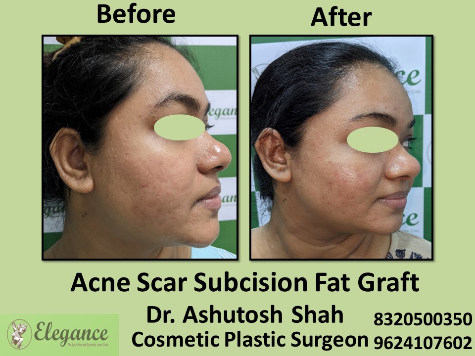 Subcision Fat Graft, Acne Treatment, Acne Removal in Vapi, Surat