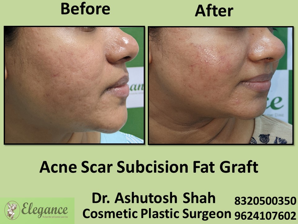 Subcision Fat Graft, Acne Treatment, Acne Removal in Athwagate, Surat