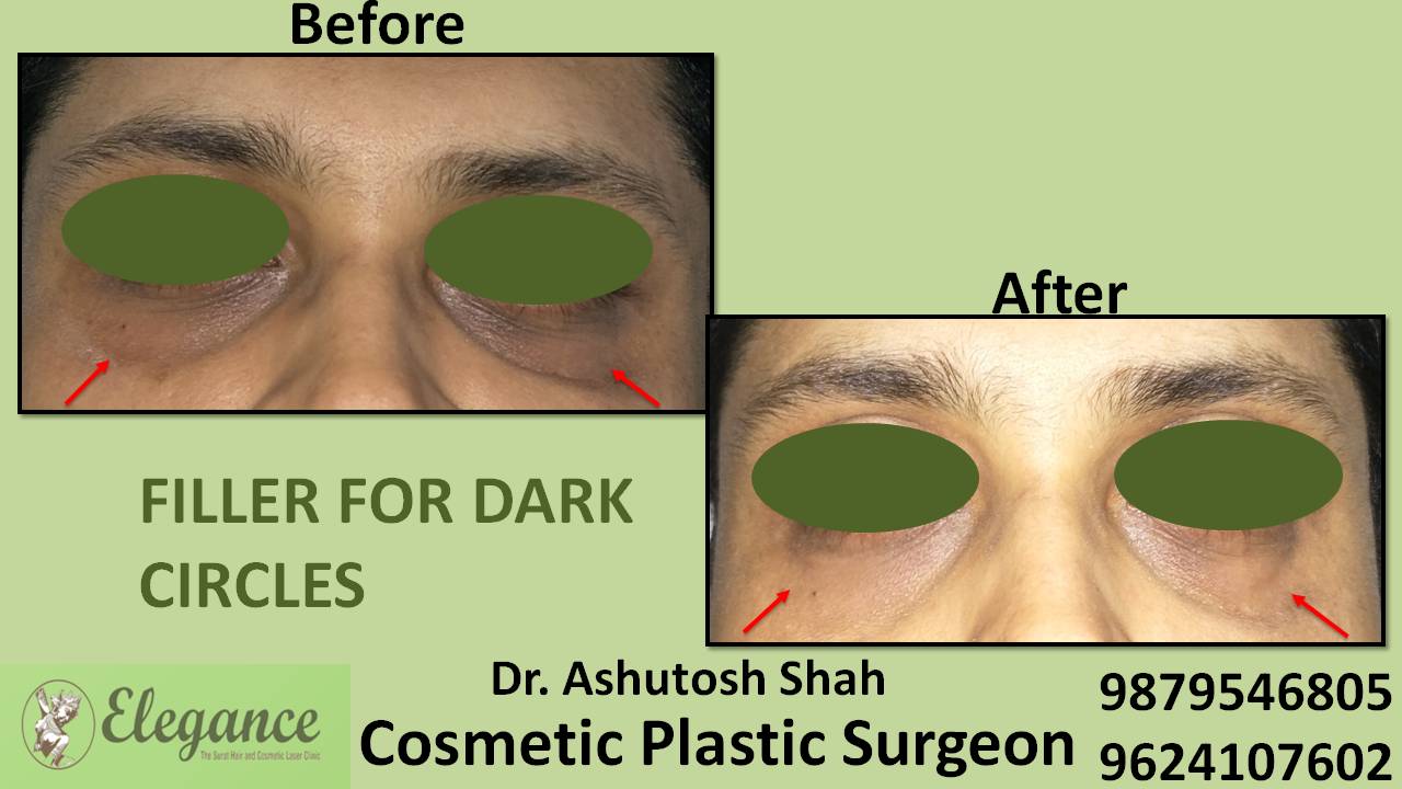 Facial Fillers Treatment in Surat, Gujarat (India)