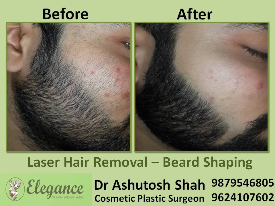 Beard removal clearance