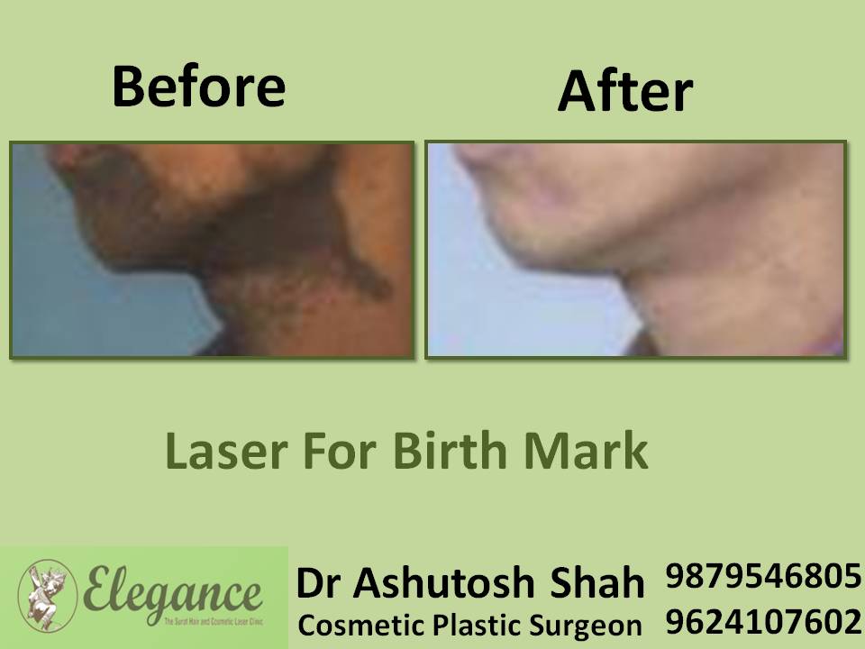 Laser Birth Mark Results In Surat, Gujarat, India