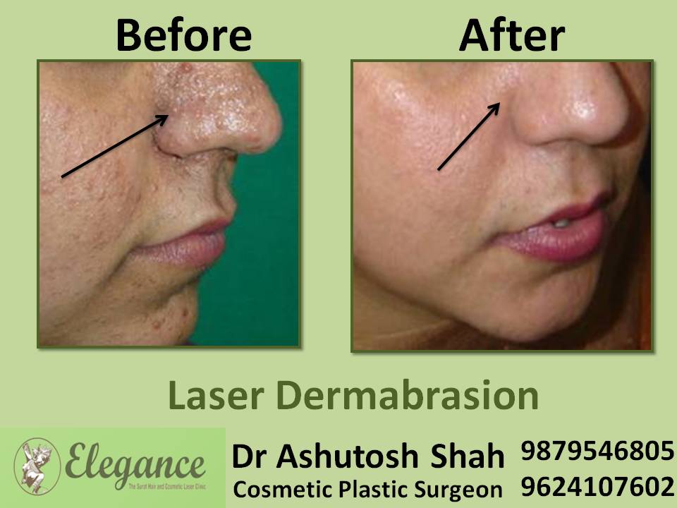 Laser Dermabrasion Cost In Surat, Gujarat, India