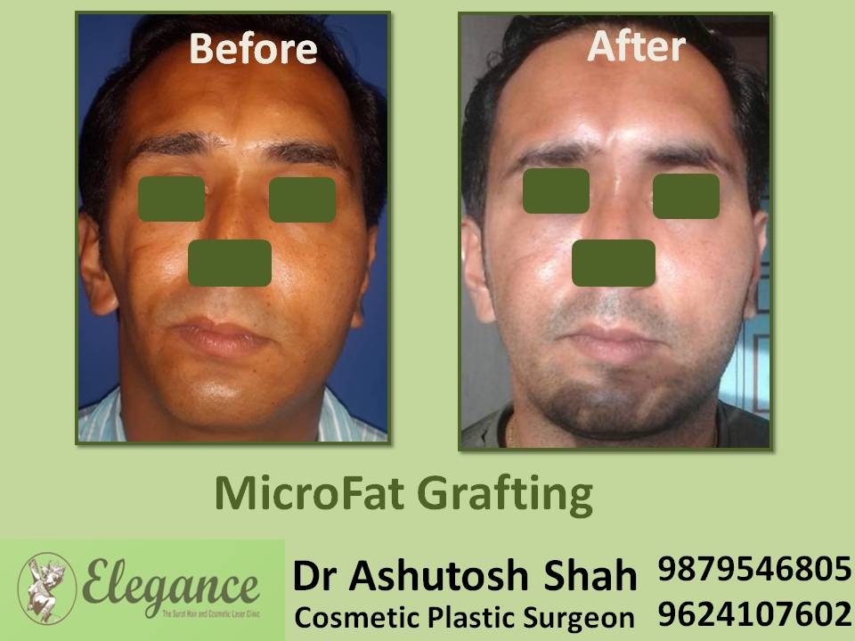 Microfat Grafting Doctor In Surat, Gujarat, India