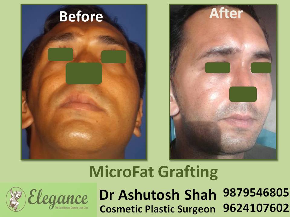 Microfat Grafting Treatment In Surat, Gujarat, India
