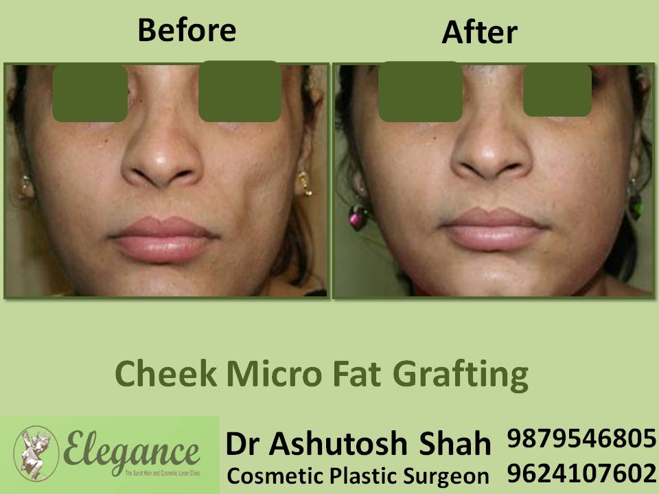Microfat Grafting Surgery In Surat, Gujarat, India