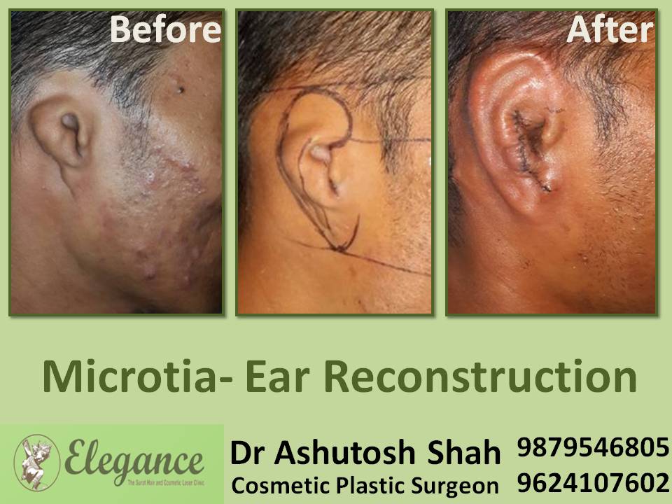 Microtia Ear Reconstruction In Surat, Gujarat, India