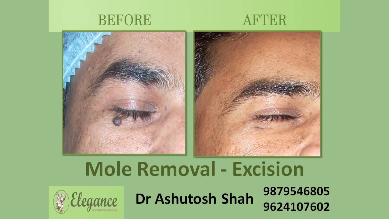 Mole Removal Excision Vadodra, Gujarat, India
