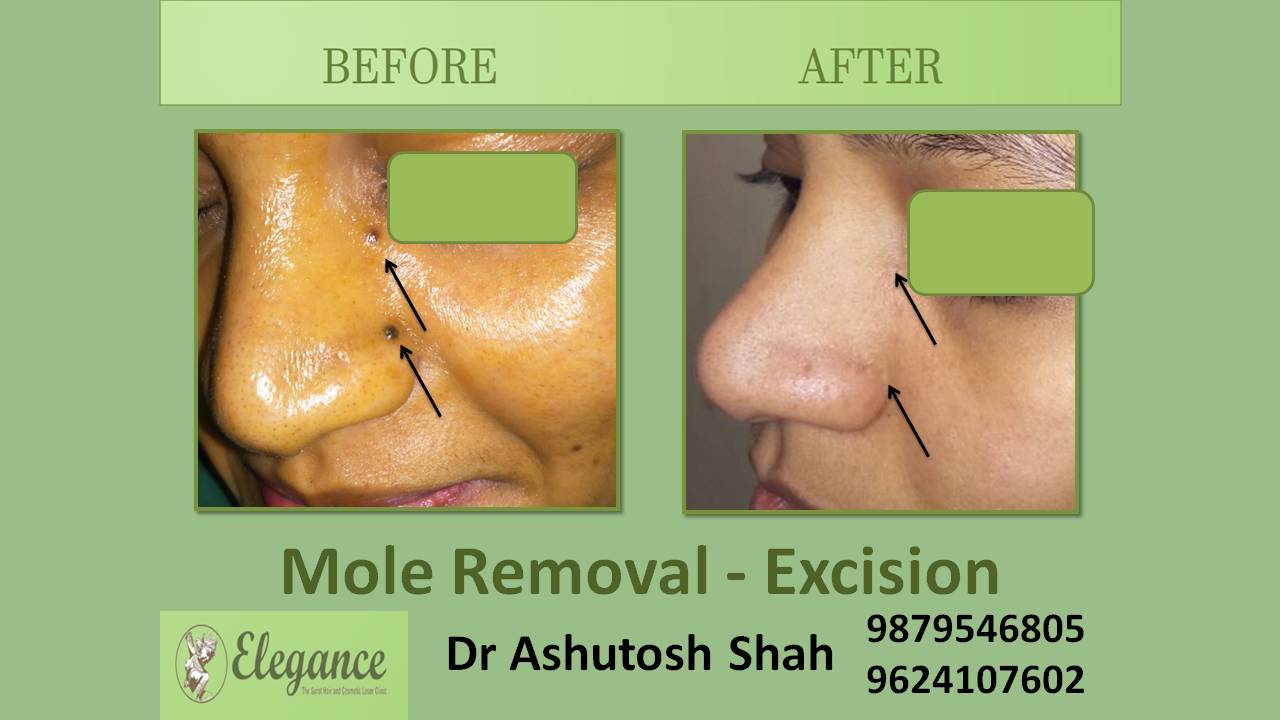 Mole Removal Excision In Bardoli, Gujarat, India