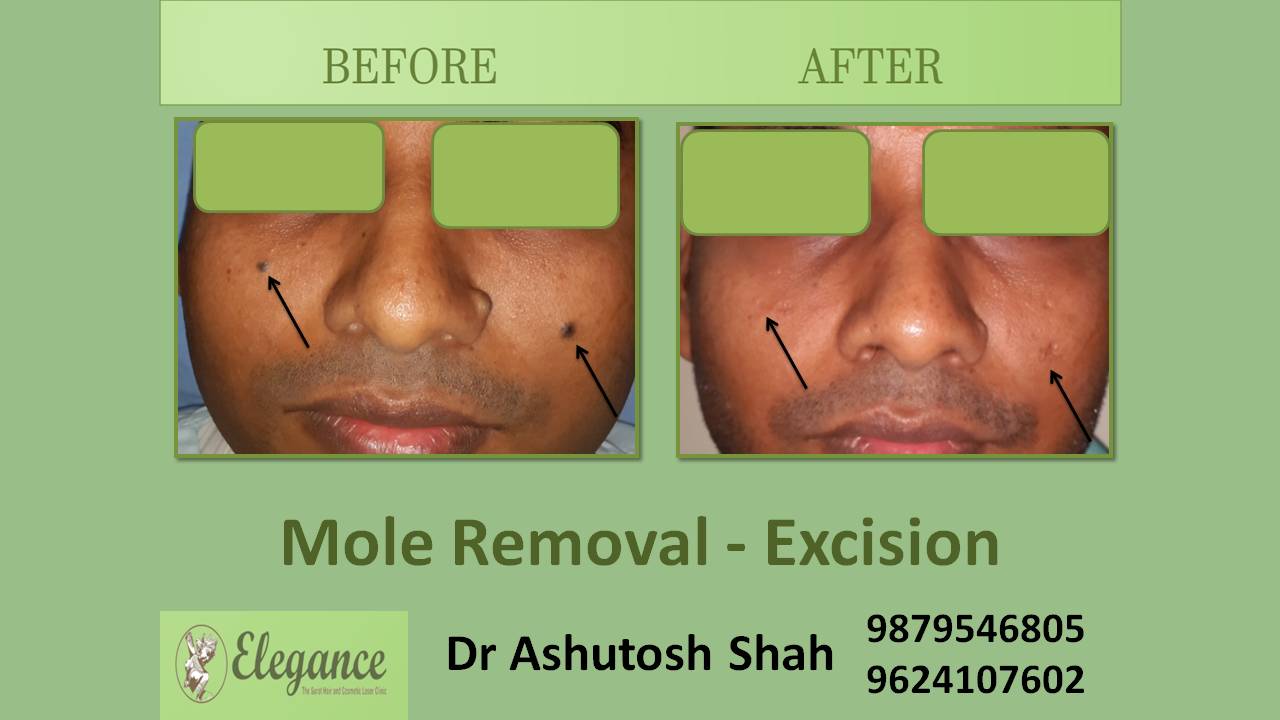 Mole Removal Excision In Vyara, Gujarat, India