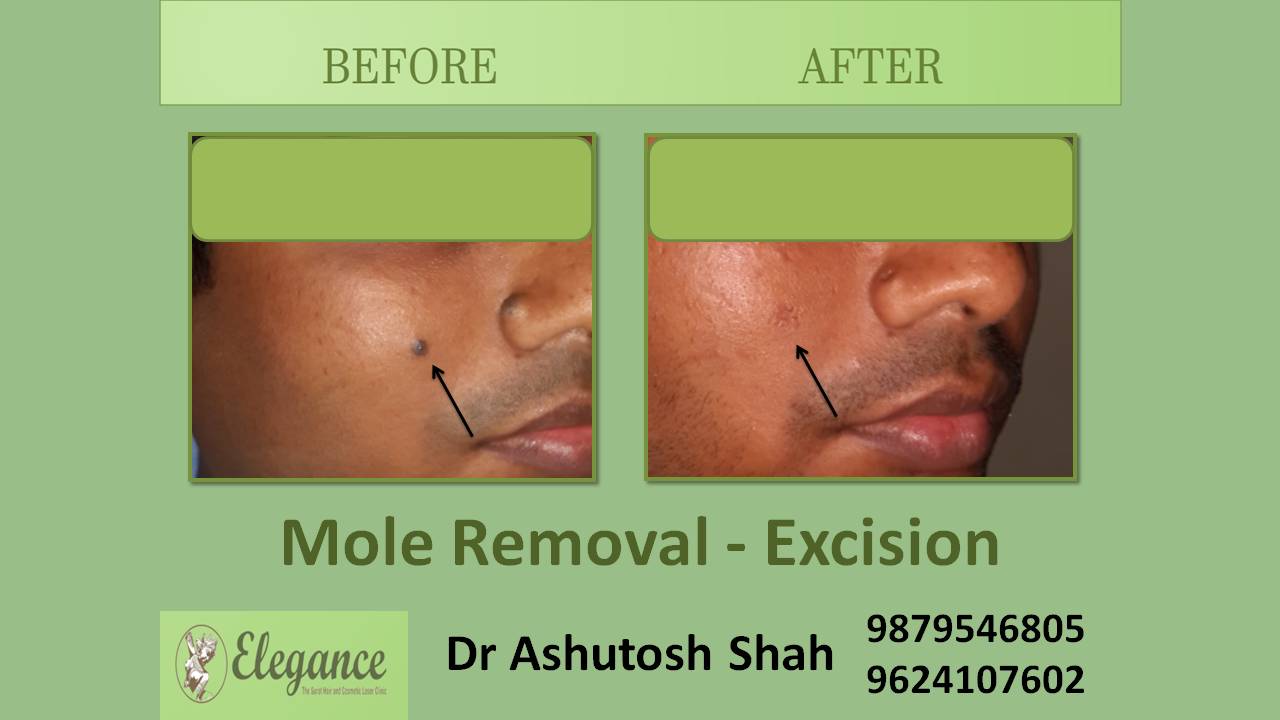 Mole Removal Excision In Baruch, Gujarat, India