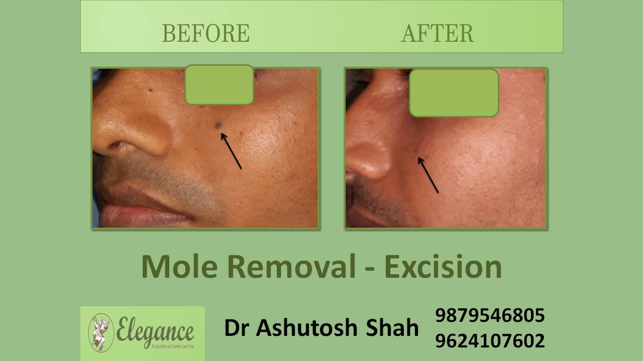 Mole Removal Excision In Ankleshwar, Gujarat, India