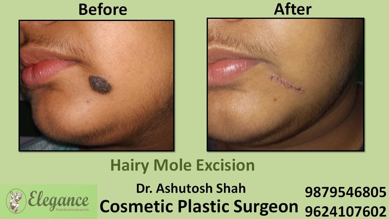 Scars, Cyst & Mole Removal in Surat, Gujarat (India)