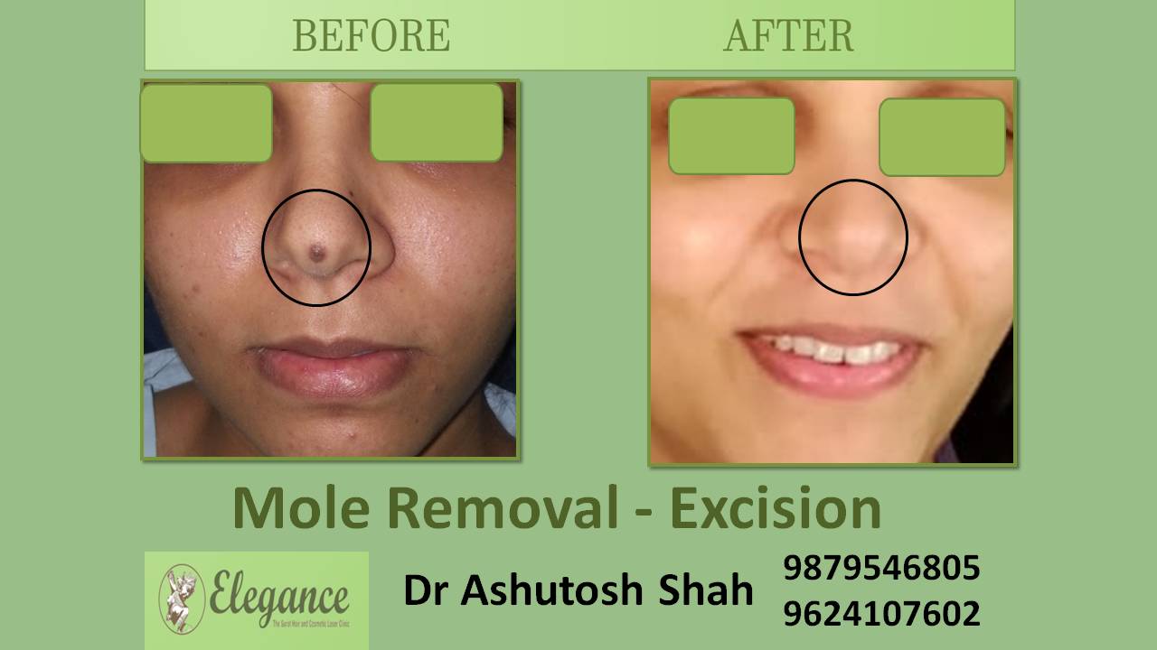 Mole Removal Excision In Valsad, Gujarat, India