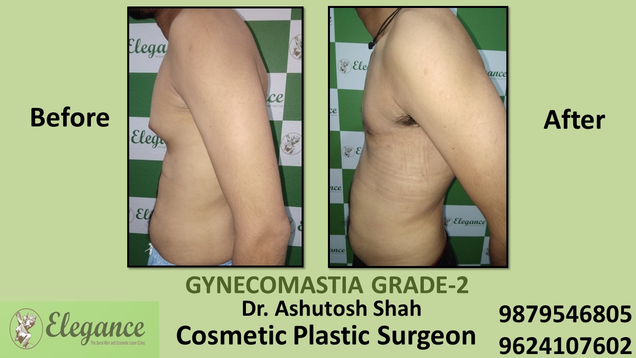 Gynecomastia Rounded Chest Grade -2 Surgery, Ankleshwar, Gujarat.