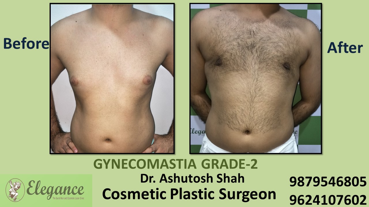 Gynecomastia Rounded Chest Grade -2 Surgery, Bardoli, Gujarat.