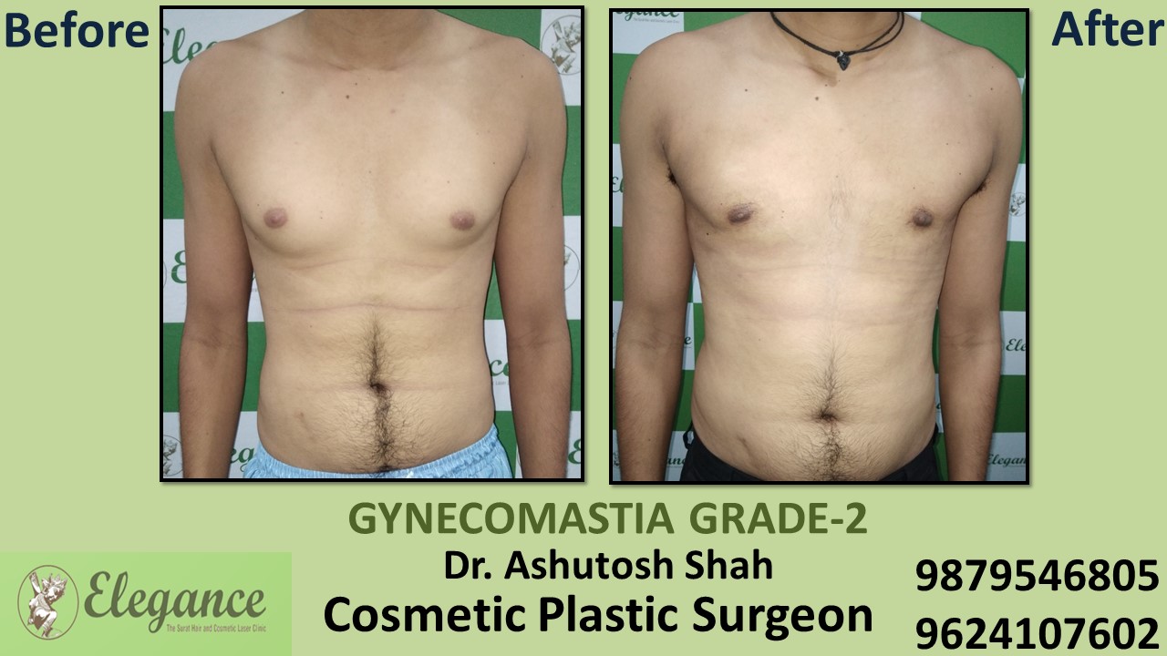Gynecomastia Rounded Chest Grade -2 Surgery, Bharuch, Gujarat.