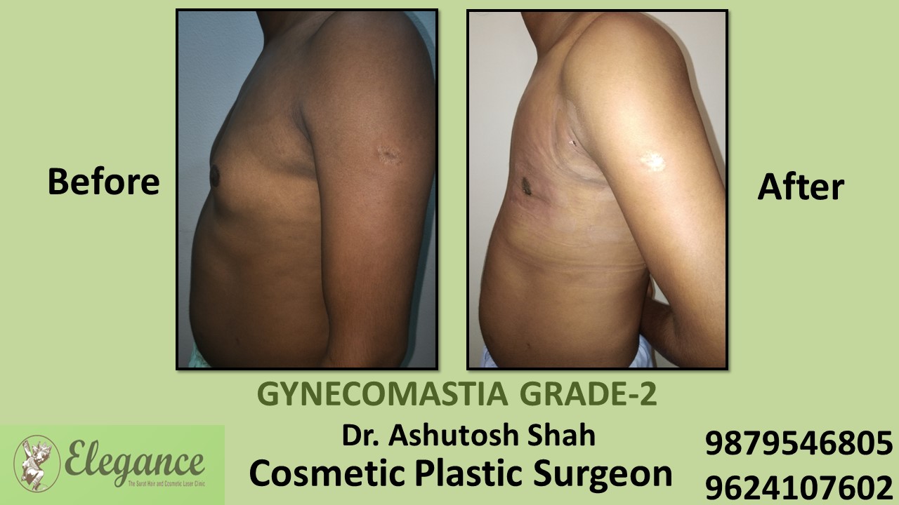 Gynecomastia Rounded Chest Grade -2 Surgery, Selvasa, Gujarat.