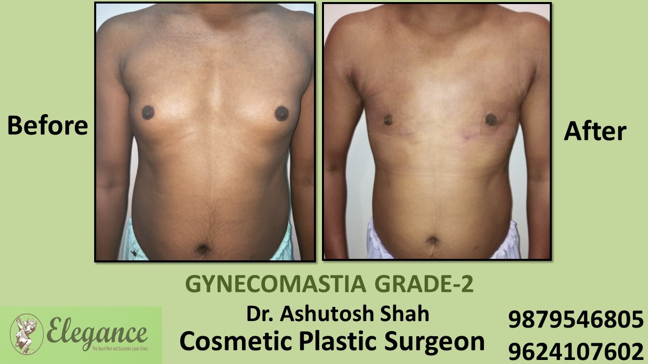 Gynecomastia Rounded Chest Grade -2 Surgery, Surat, Gujarat.