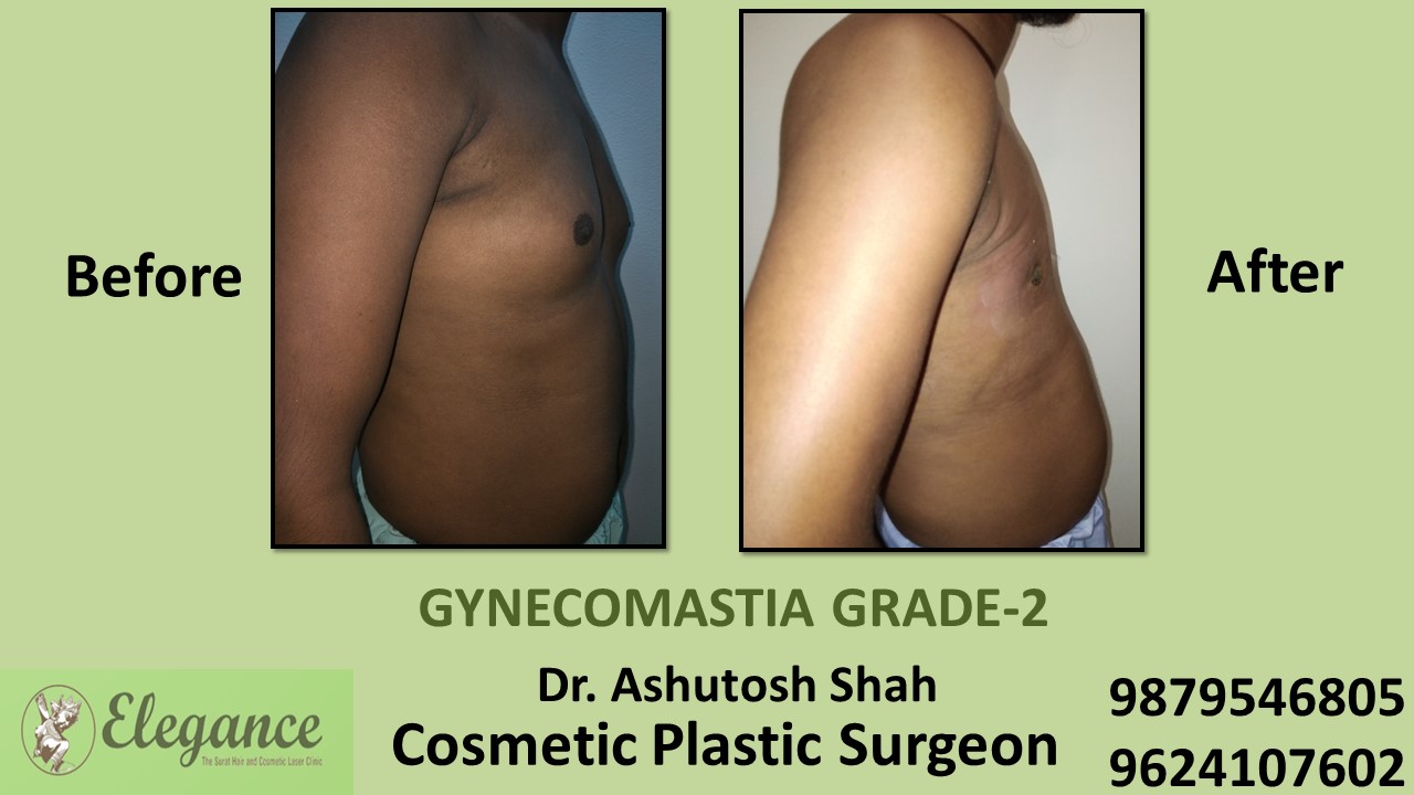 Gynecomastia Rounded Chest Grade -2 Surgery, Vadodara, Gujarat.