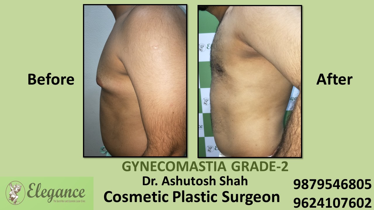 Gynecomastia Rounded Chest Grade -2 Surgery, Valsad, Gujarat.