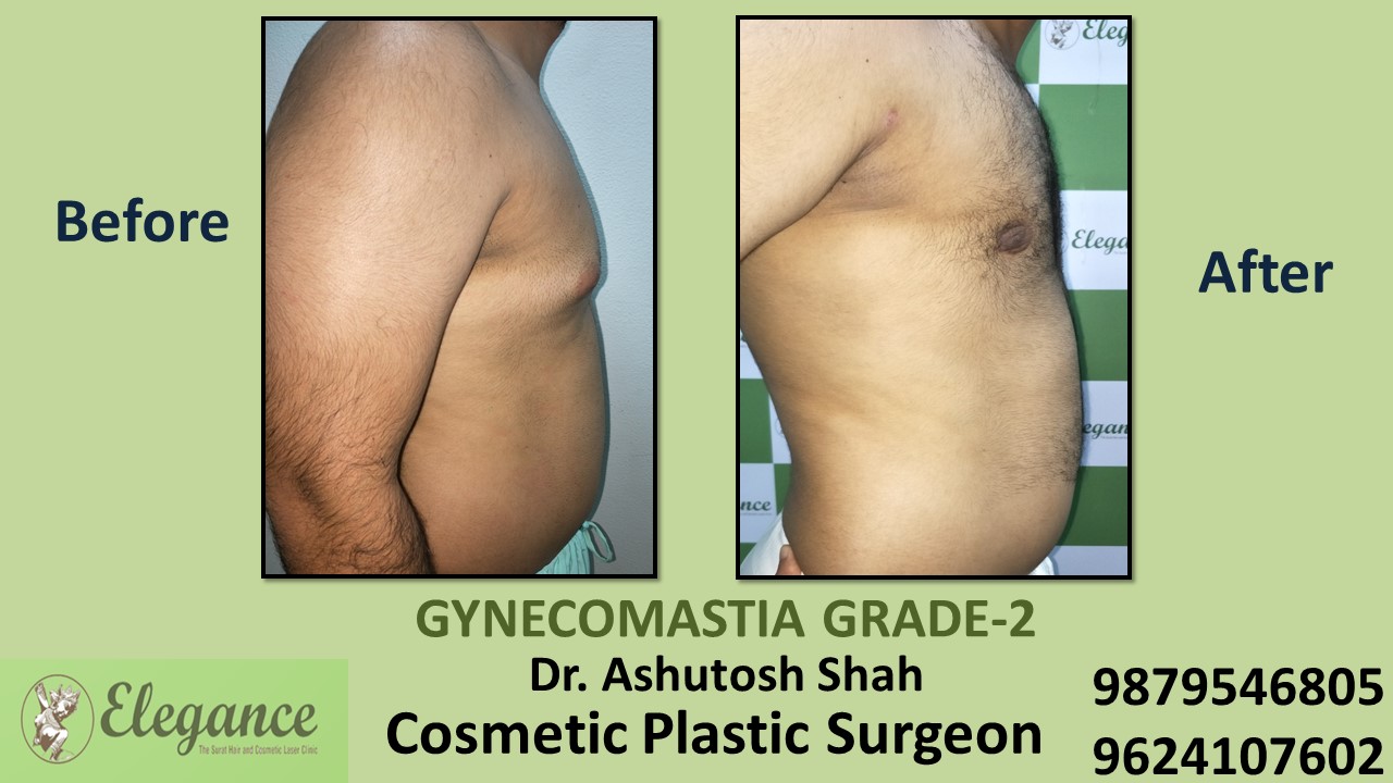 Gynecomastia Rounded Chest Grade -2 Surgery, Vapi, Gujarat.