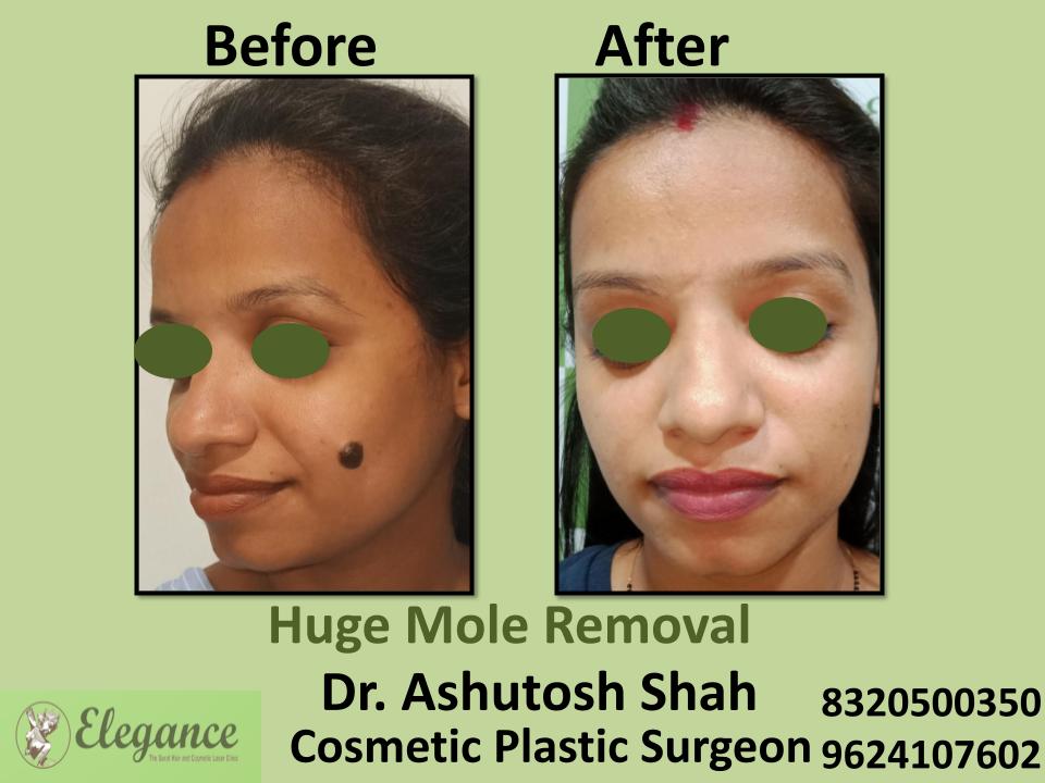 Huge Mole Removal, Surgical Removal Of Mole, Affordable Cost Surgery Bhatar, Piplod, Dindoli, Olpad, Surat, Gujarat.
